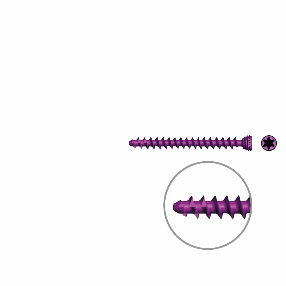 Spongiosaschraube Ø3,0mm, 30mm winkelstabil/ TI selbstschneidend 